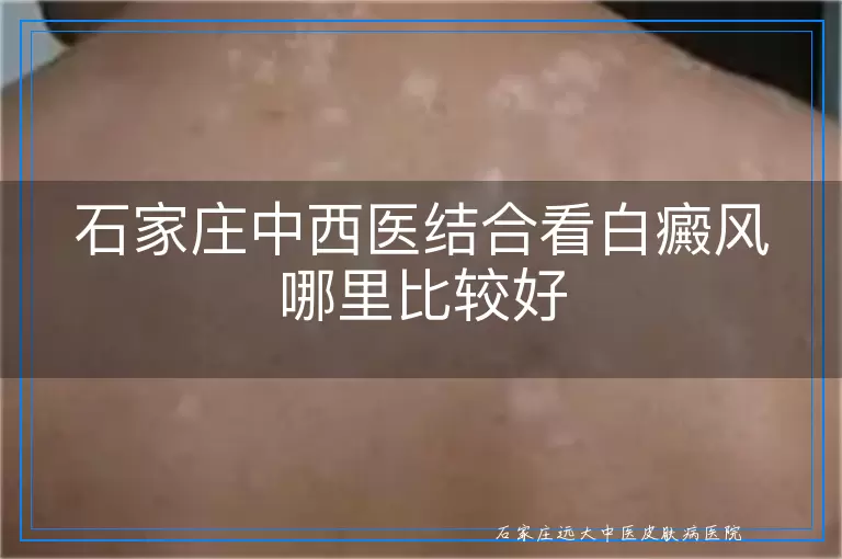 石家庄中西医结合看白癜风哪里比较好