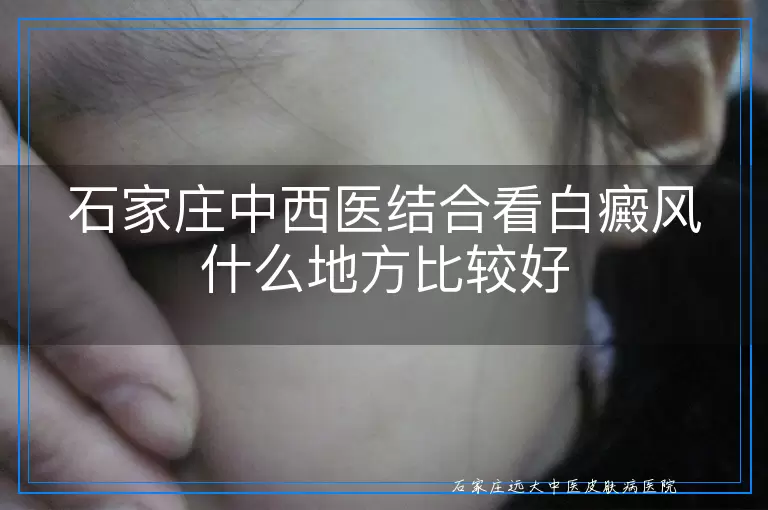 石家庄中西医结合看白癜风什么地方比较好