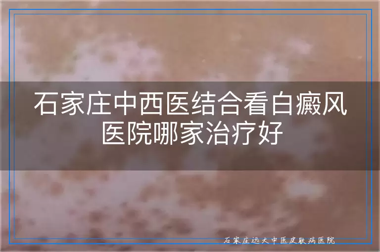 石家庄中西医结合看白癜风医院哪家治疗好