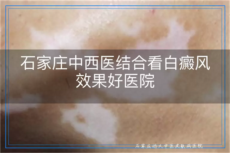 石家庄中西医结合看白癜风效果好医院