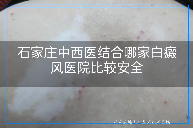 石家庄中西医结合哪家白癜风医院比较安全