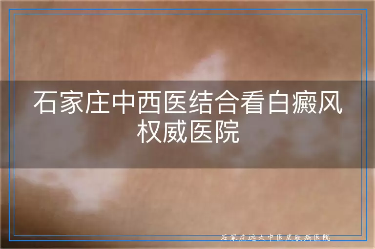 石家庄中西医结合看白癜风权威医院