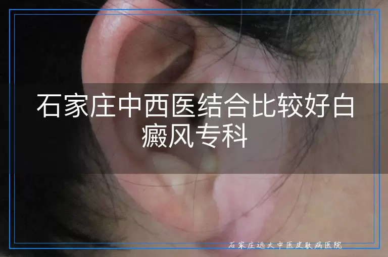 石家庄中西医结合比较好白癜风专科