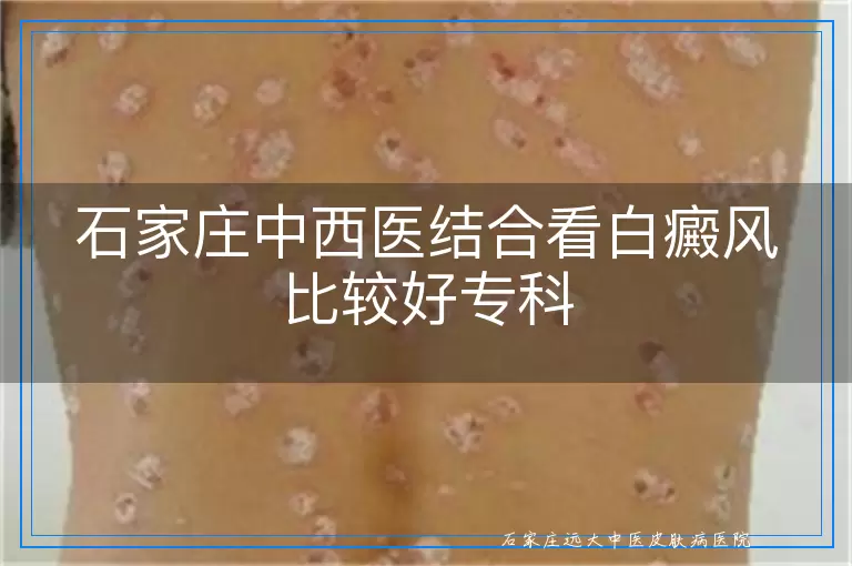 石家庄中西医结合看白癜风比较好专科