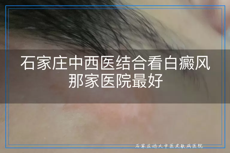 石家庄中西医结合看白癜风那家医院最好