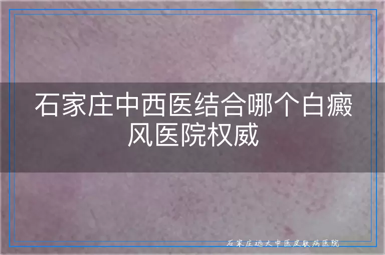 石家庄中西医结合哪个白癜风医院权威