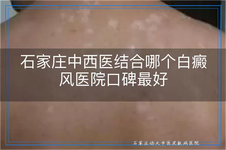 石家庄中西医结合哪个白癜风医院口碑最好