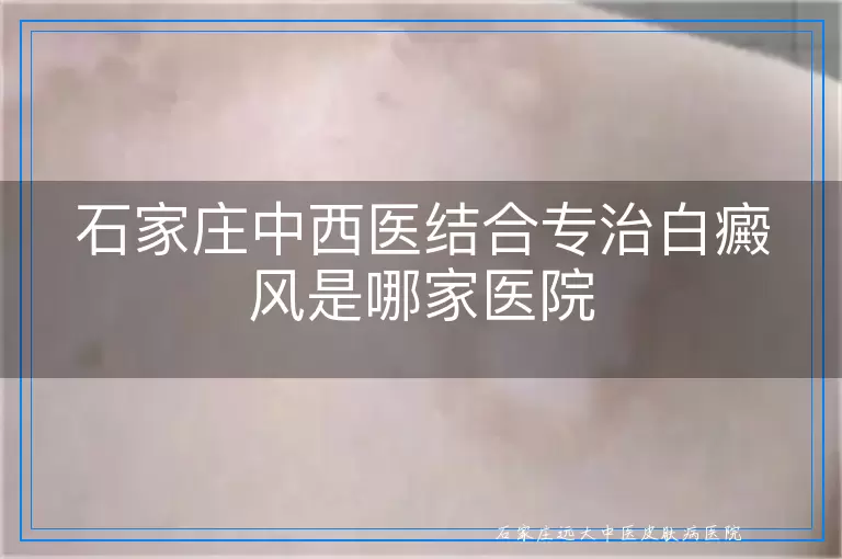 石家庄中西医结合专治白癜风是哪家医院