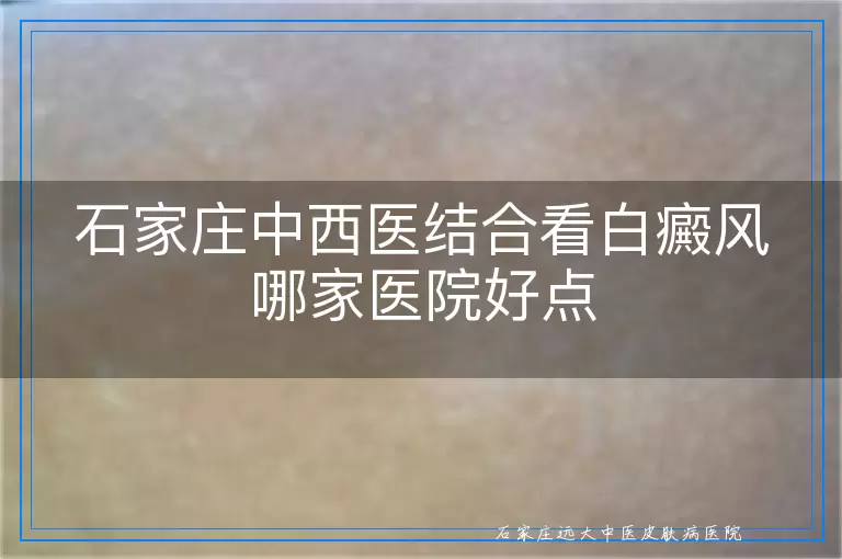 石家庄中西医结合看白癜风哪家医院好点