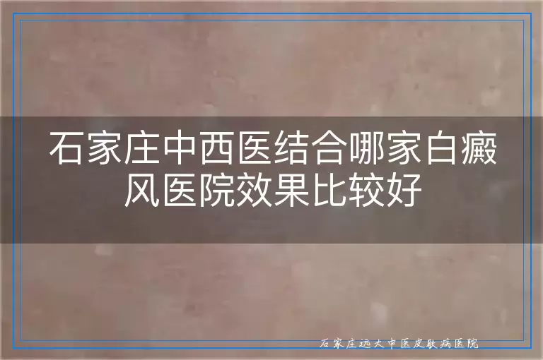 石家庄中西医结合哪家白癜风医院效果比较好