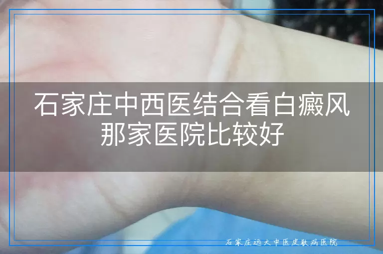 石家庄中西医结合看白癜风那家医院比较好