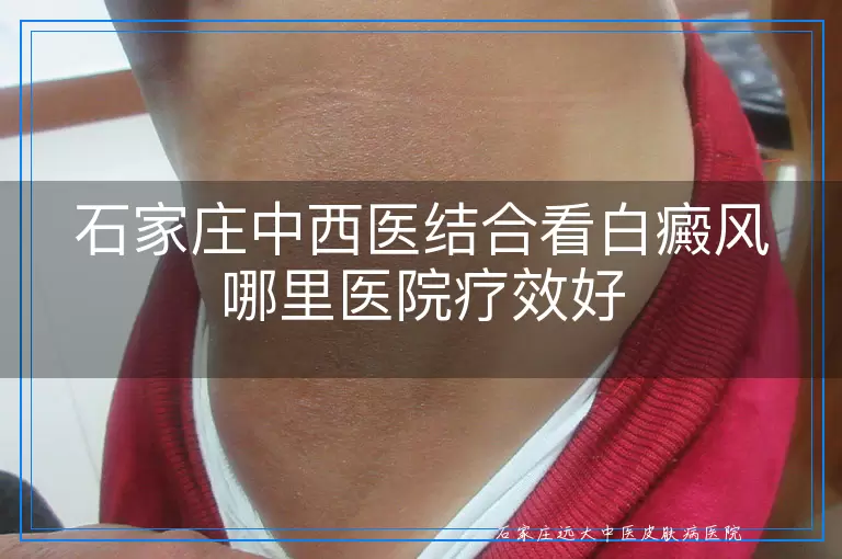 石家庄中西医结合看白癜风哪里医院疗效好