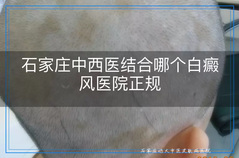 石家庄中西医结合哪个白癜风医院正规