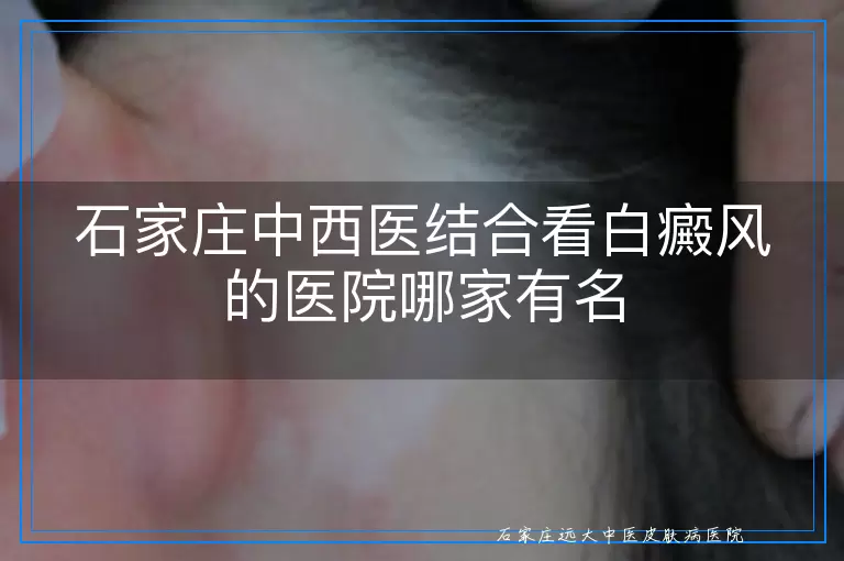 石家庄中西医结合看白癜风的医院哪家有名