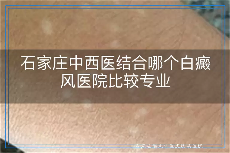 石家庄中西医结合哪个白癜风医院比较专业