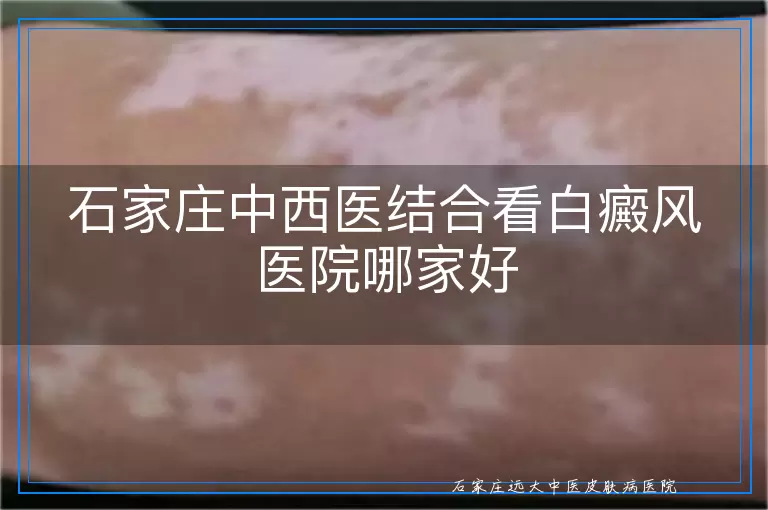 石家庄中西医结合看白癜风医院哪家好