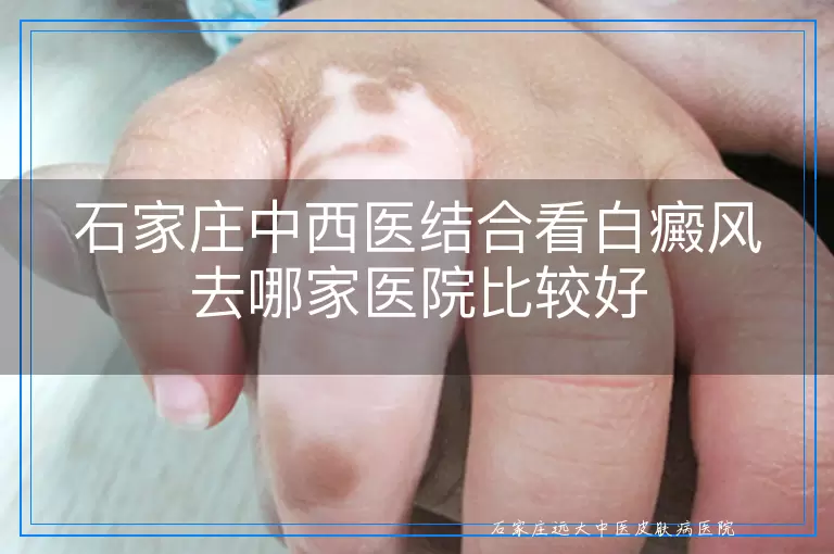 石家庄中西医结合看白癜风去哪家医院比较好
