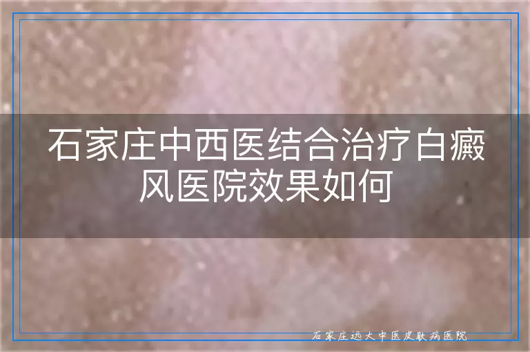 石家庄中西医结合治疗白癜风医院效果如何