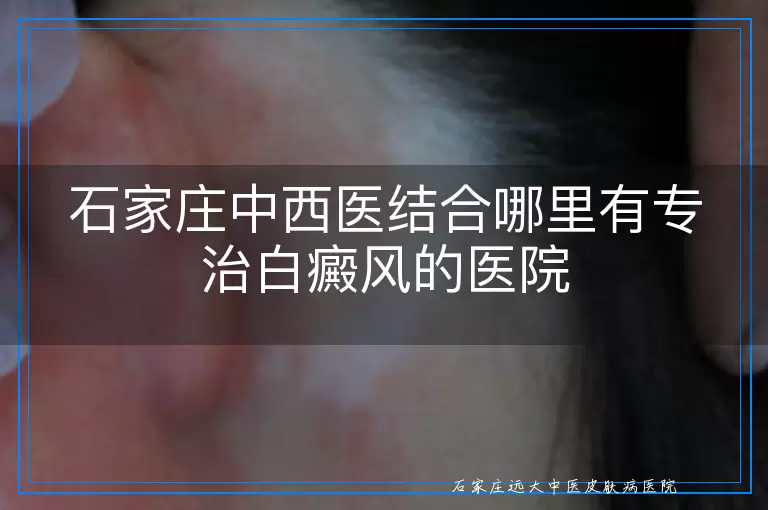 石家庄中西医结合哪里有专治白癜风的医院