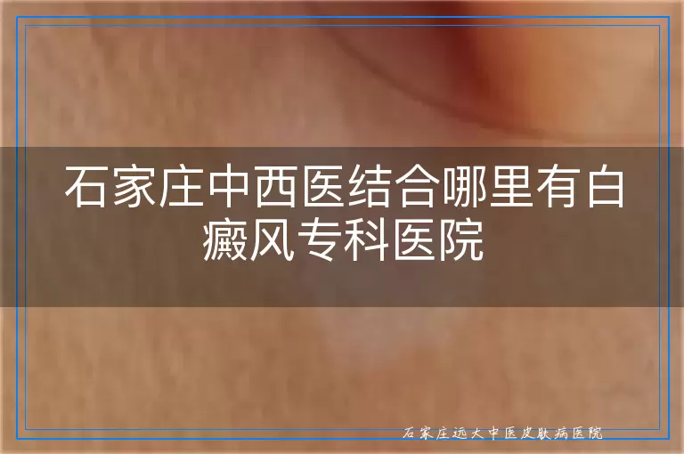 石家庄中西医结合哪里有白癜风专科医院