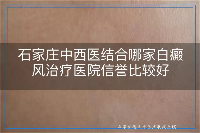 石家庄中西医结合哪家白癜风治疗医院信誉比较好