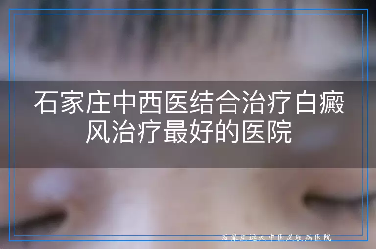石家庄中西医结合治疗白癜风治疗最好的医院