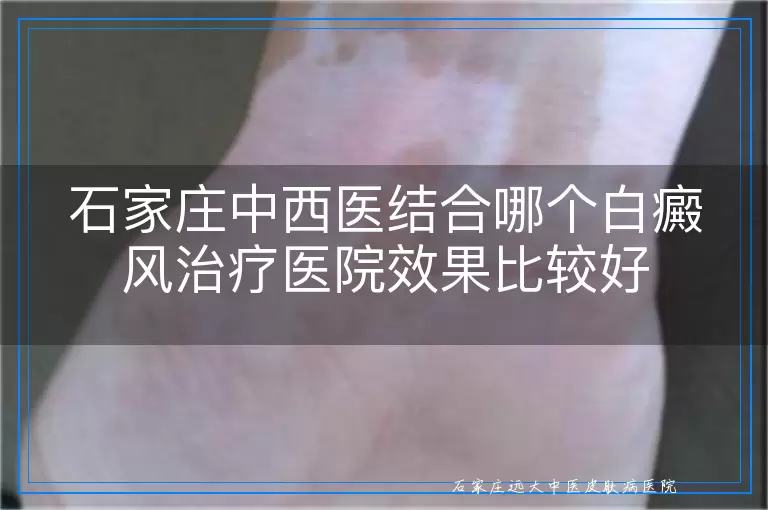 石家庄中西医结合哪个白癜风治疗医院效果比较好