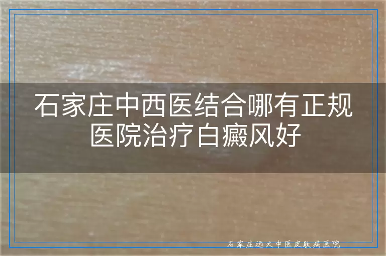 石家庄中西医结合哪有正规医院治疗白癜风好