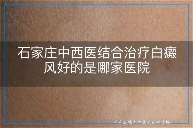 石家庄中西医结合治疗白癜风好的是哪家医院