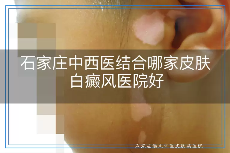 石家庄中西医结合哪家皮肤白癜风医院好