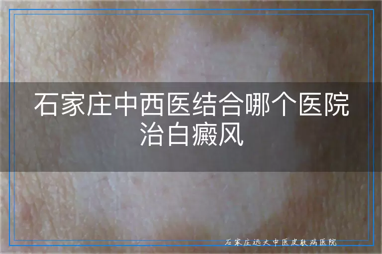石家庄中西医结合哪个医院治白癜风