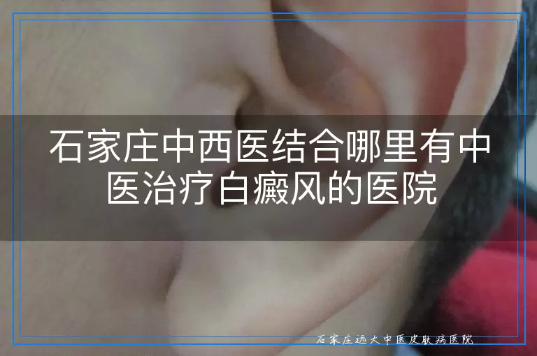 石家庄中西医结合哪里有中医治疗白癜风的医院