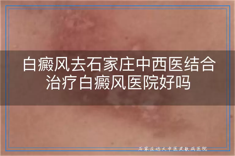 白癜风去石家庄中西医结合治疗白癜风医院好吗