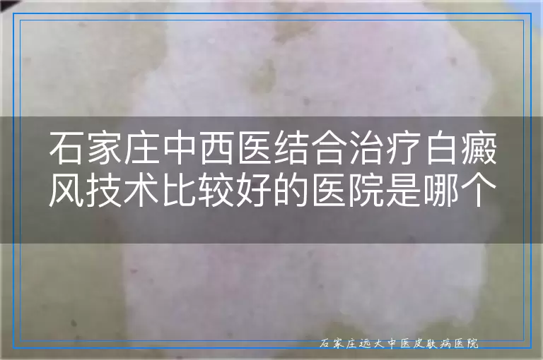 石家庄中西医结合治疗白癜风技术比较好的医院是哪个