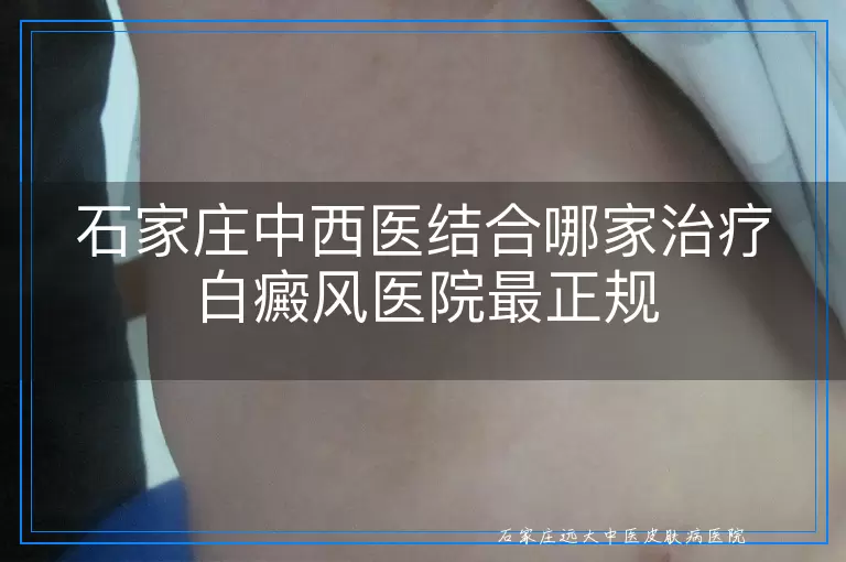 石家庄中西医结合哪家治疗白癜风医院最正规