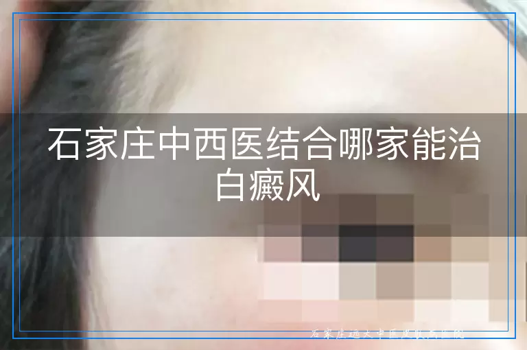 石家庄中西医结合哪家能治白癜风
