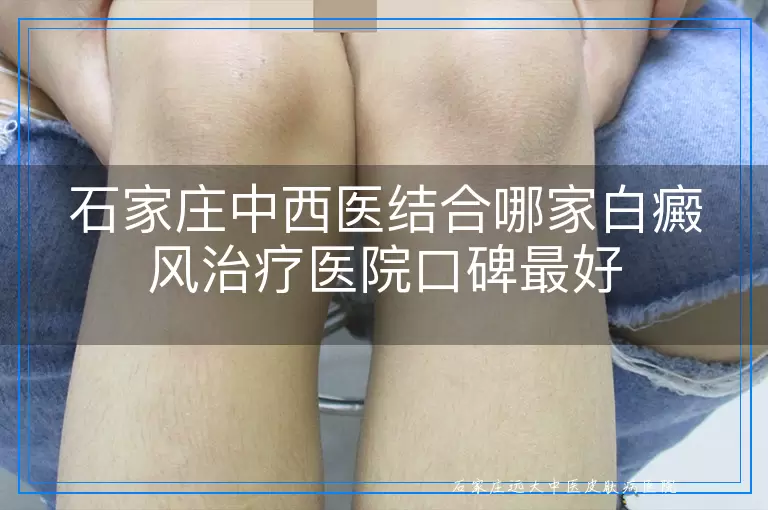 石家庄中西医结合哪家白癜风治疗医院口碑最好