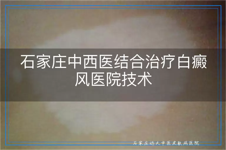 石家庄中西医结合治疗白癜风医院技术
