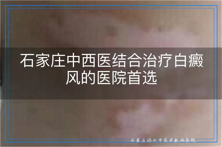 石家庄中西医结合治疗白癜风的医院首选