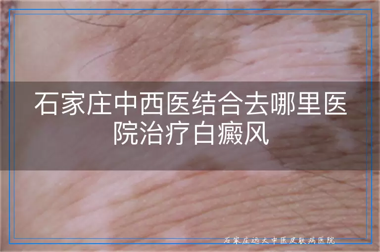 石家庄中西医结合去哪里医院治疗白癜风
