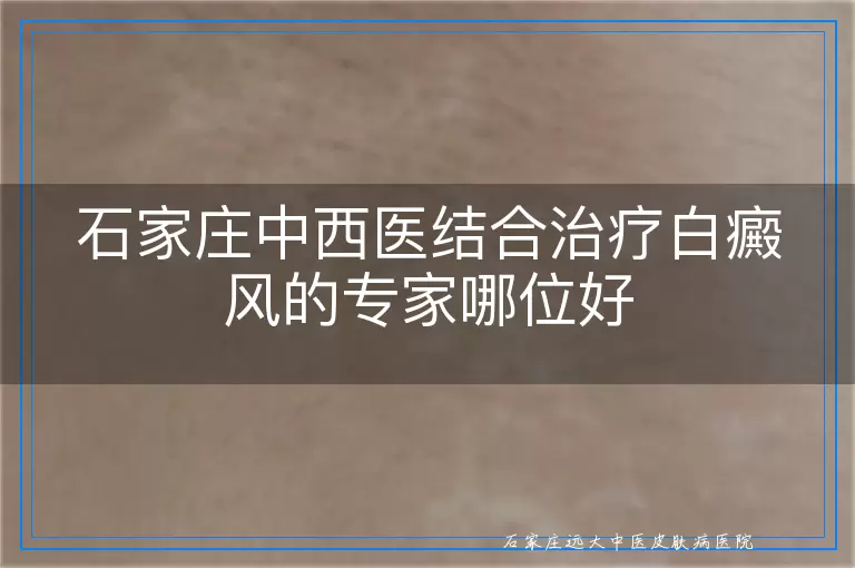 石家庄中西医结合治疗白癜风的专家哪位好