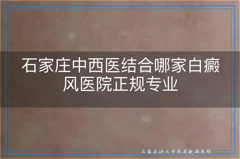 石家庄中西医结合哪家白癜风医院正规专业