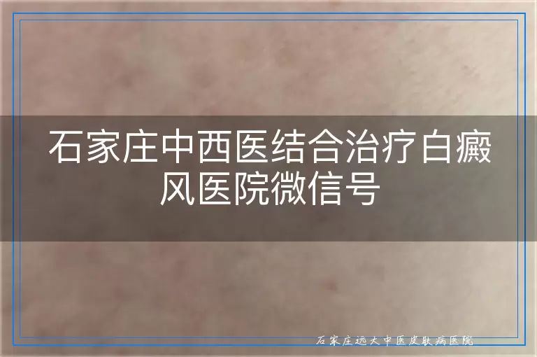 石家庄中西医结合治疗白癜风医院微信号