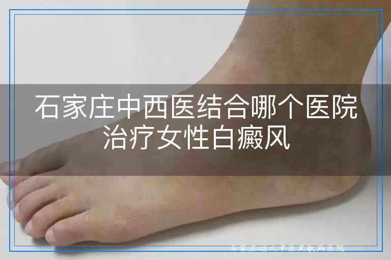 石家庄中西医结合哪个医院治疗女性白癜风