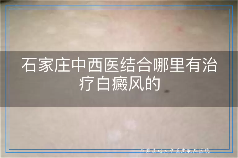 石家庄中西医结合哪里有治疗白癜风的