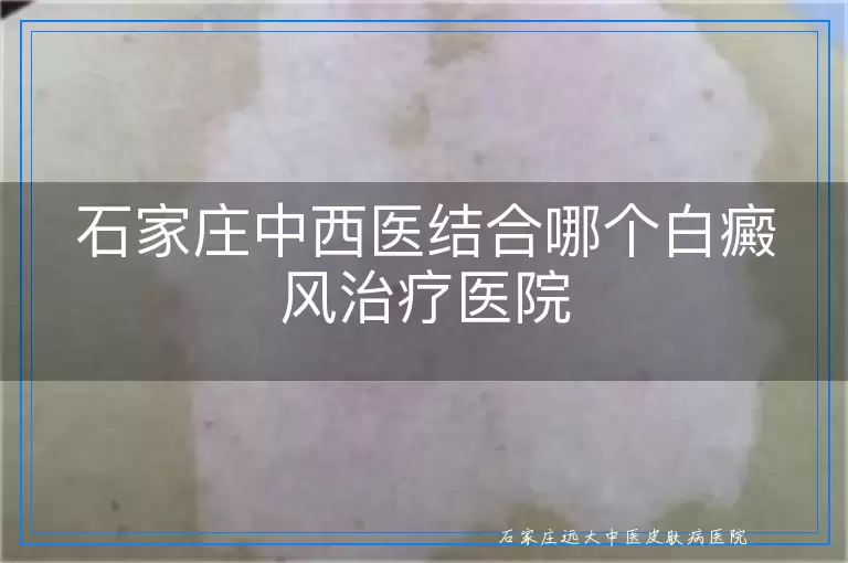 石家庄中西医结合哪个白癜风治疗医院