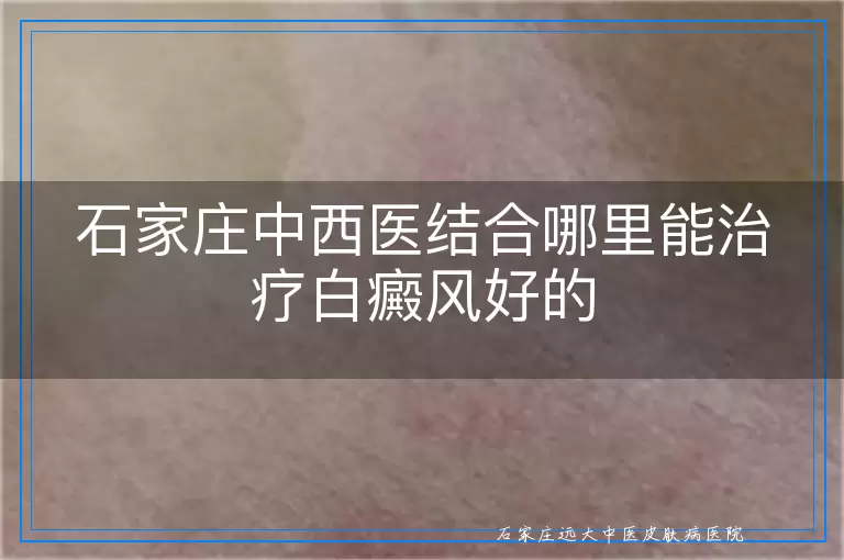 石家庄中西医结合哪里能治疗白癜风好的