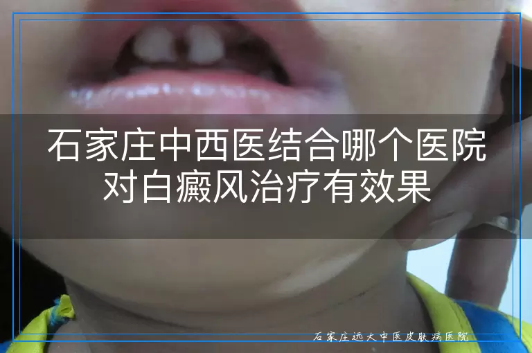 石家庄中西医结合哪个医院对白癜风治疗有效果