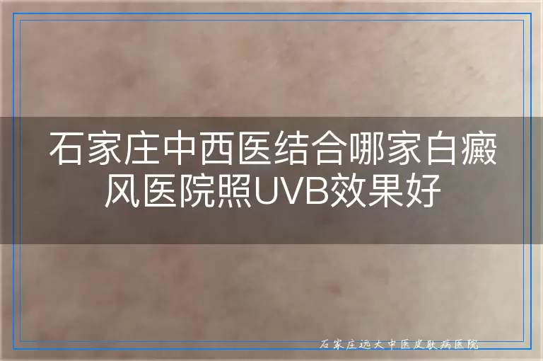 石家庄中西医结合哪家白癜风医院照UVB效果好