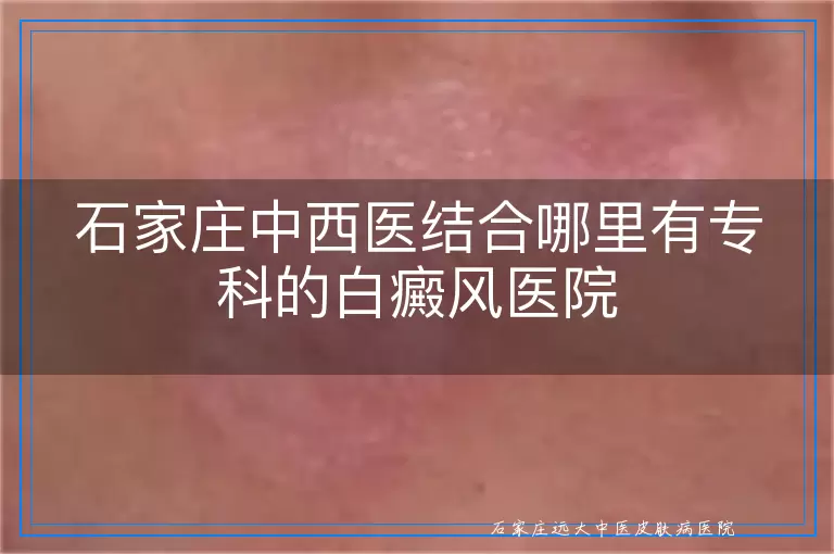 石家庄中西医结合哪里有专科的白癜风医院